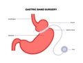 Gastric band poster Royalty Free Stock Photo