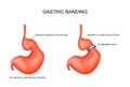 Gastric band, stretched from overeating