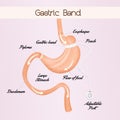 Gastric band to reduce stomach