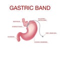 Gastric Band Weight Loss Surgery.Band with a Port that Under the Skin