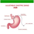 Gastric Band Weight Loss Surgery.Band with a Port that Under the Skin