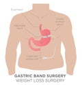 Gastric Band Weight Loss Surgery