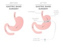 Gastric Band Weight Loss Surgery