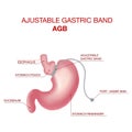 Gastric Band Weight Loss Surgery.Band with a Port that Under the Skin