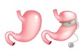 Gastric Banding Surgery