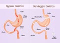 Gastric bypass and gastric band Royalty Free Stock Photo