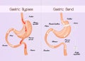 Gastric bypass and gastric band