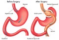 Gastric bypass