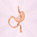 Gastric bypass surgery