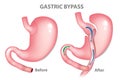 Gastric bypass surgery Royalty Free Stock Photo