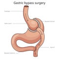 Gastric bypass surgery diagram medical science Royalty Free Stock Photo