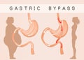 Gastric bypass to reduce stomach