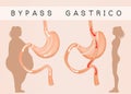 Gastric bypass to reduce stomach