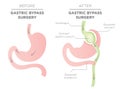 Gastric Bypass for Weight Loss