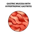 Gastric mucosa with hypertrophic gastritis. Infographics. Vector illustration on isolated background