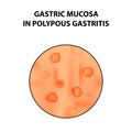 Gastric mucosa in polypous gastritis. Infographics. Vector illustration on isolated background