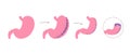 Gastric plication flat infographics. The explanation picture of stomach reduce method via laparoscopic operation Royalty Free Stock Photo