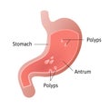 Gastric polyps, masses of cells that form on the lining inside stomach. pedunculated and flat-based polyp. Antrum. Medical vector