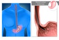 Gastric polyps. Stomach Upper endoscopy.