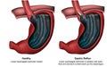 Gastric reflux 3d medical illustration with english description