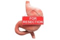 Gastric resection concept. Human stomach with For Resection hanging sign, 3D rendering