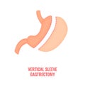 Gastric sleeve bariatric surgery weight loss infographics