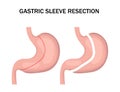 Gastric sleeve resection infographic. Stomach reduction surgery for weight loss. Medicine concept. Vector illustration