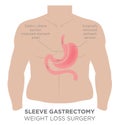 Gastric Sleeve Weight Loss Surgery