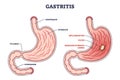 Gastritis as stomach lining inflammation illness and disease outline diagram Royalty Free Stock Photo