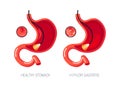 Gastritis concept in flat style, icon