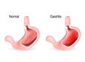 Gastritis. Cross section of two stomach Royalty Free Stock Photo