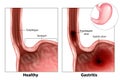 Gastritis and Esophageal ulcer