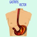 Gastritis Royalty Free Stock Photo
