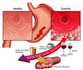 Gastritis