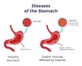 Gastritis Stomach Set