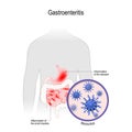 Gastroenteritis. Viral disease that caused by noroviruses