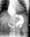 Gastroesofageal examination xray barrium swallow