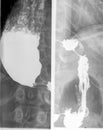 Gastroesofageal examination xray barrium swallow