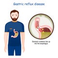 Gastroesophageal reflux disease. Close-up of stomach with GERD