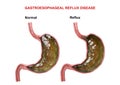 Gastroesophageal Reflux Disease - failure of the digestive mechanism sphincter that causes passage of gastric acid into the