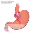 Gastroesophageal reflux disease GERD Royalty Free Stock Photo