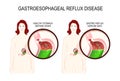 Gastroesophageal reflux disease. gerd