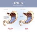 Gastroesophageal reflux disease. Healthy and sick Royalty Free Stock Photo