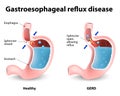Gastroesophageal Reflux Disease Royalty Free Stock Photo