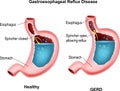 Gastroesophageal reflux disease Royalty Free Stock Photo