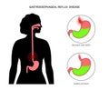 Gastroesophageal reflux disease