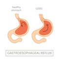 Gastroesophageal reflux disease Royalty Free Stock Photo