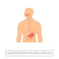 Gastroesophageal reflux disease Royalty Free Stock Photo