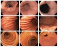 Gastrointestinal endoscopic image of Esophagogastroduodenoscopy through esophagus stomach and duodenum with CLO test