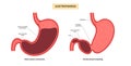 Gastroparesis anatomical poster